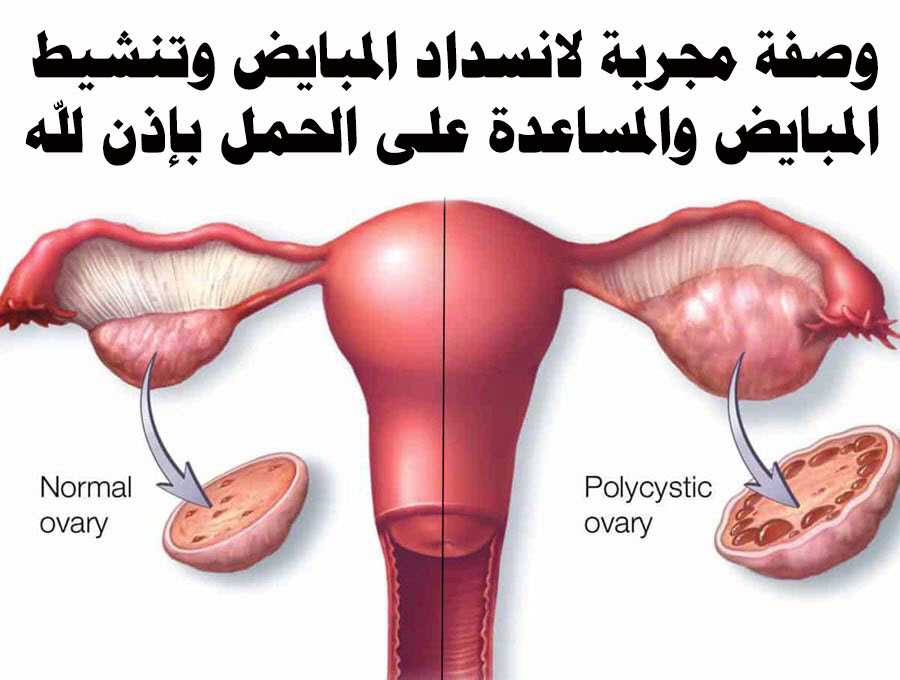 وصفة مجربة وطبيعية لتنشيط المبايض وزيادة التبويض