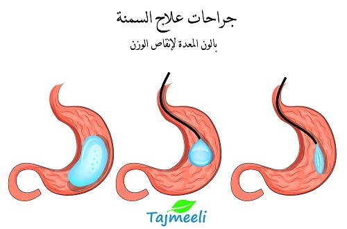 تجربتي مع عملية بالون المعده