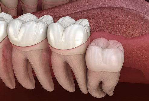 علاج فعال بعد خلع ضرس العقل 91332