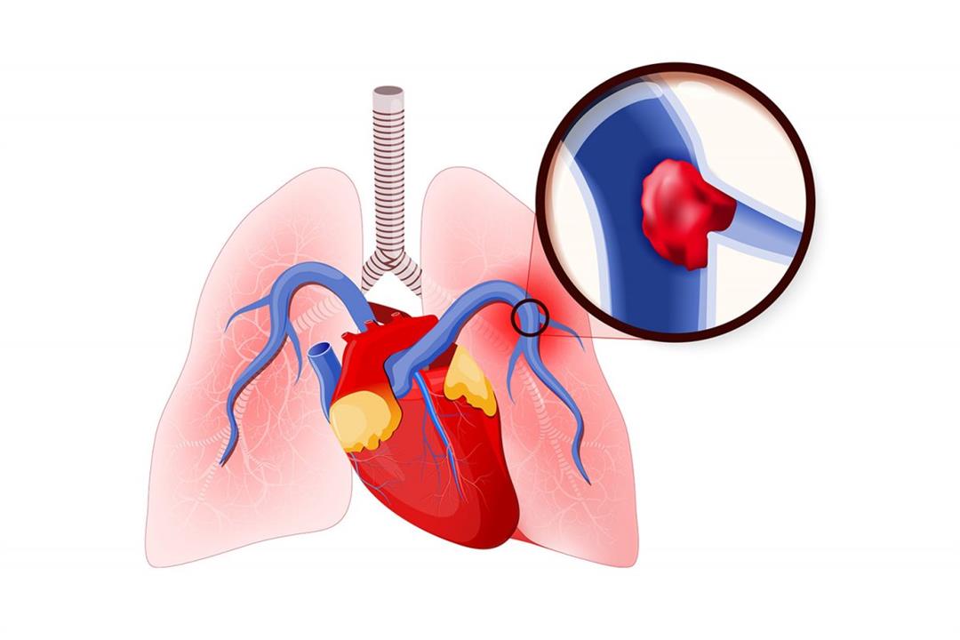 اسباب الجلطة الرئوية - الامراض الصدرية المفاجاءة 94748