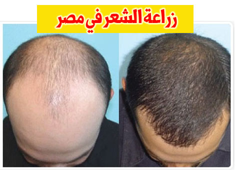 تجربتي مع زراعة الشعر في مصر - انبات الشعر بالجراحة 94699 1