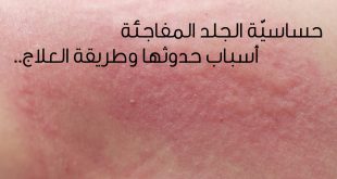 94534 1 310x165 سبب حكة حساسية المفاجئة الجلد الجسم اسباب