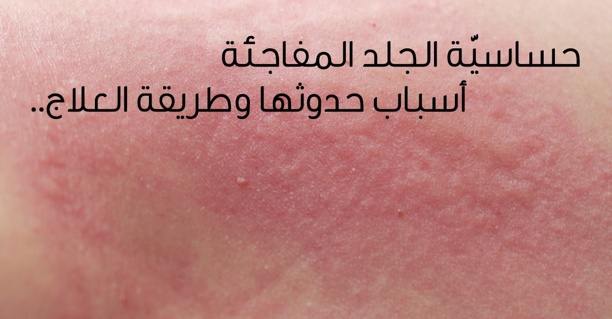 94534 اسباب حساسية الجلد المفاجئة - ما سبب حكة الجسم عتاب