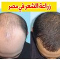 94699 1 تجربتي مع زراعة الشعر في مصر - انبات الشعر بالجراحة ابتسامة البلد