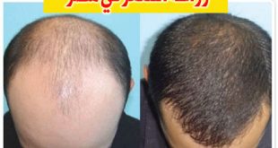 94699 1 310x165 مع مصر في زراعة تجربتي بالجراحة انبات الشعر